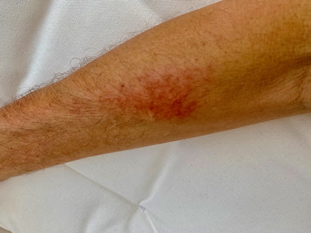 A red rash on an arm from jellyfish A red rash on an arm from jellyfish