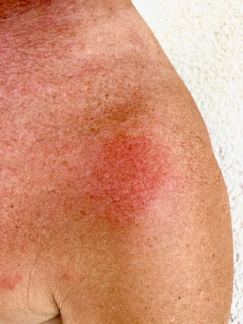 Red jellyfish sting on a man's shoulder. Red jellyfish sting on a man's shoulder.
