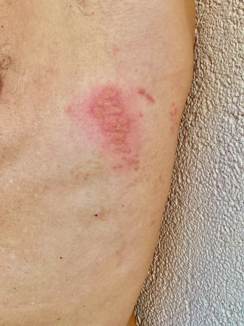 Red rash on torso from jellyfish sting. Red rash on torso from jellyfish sting.