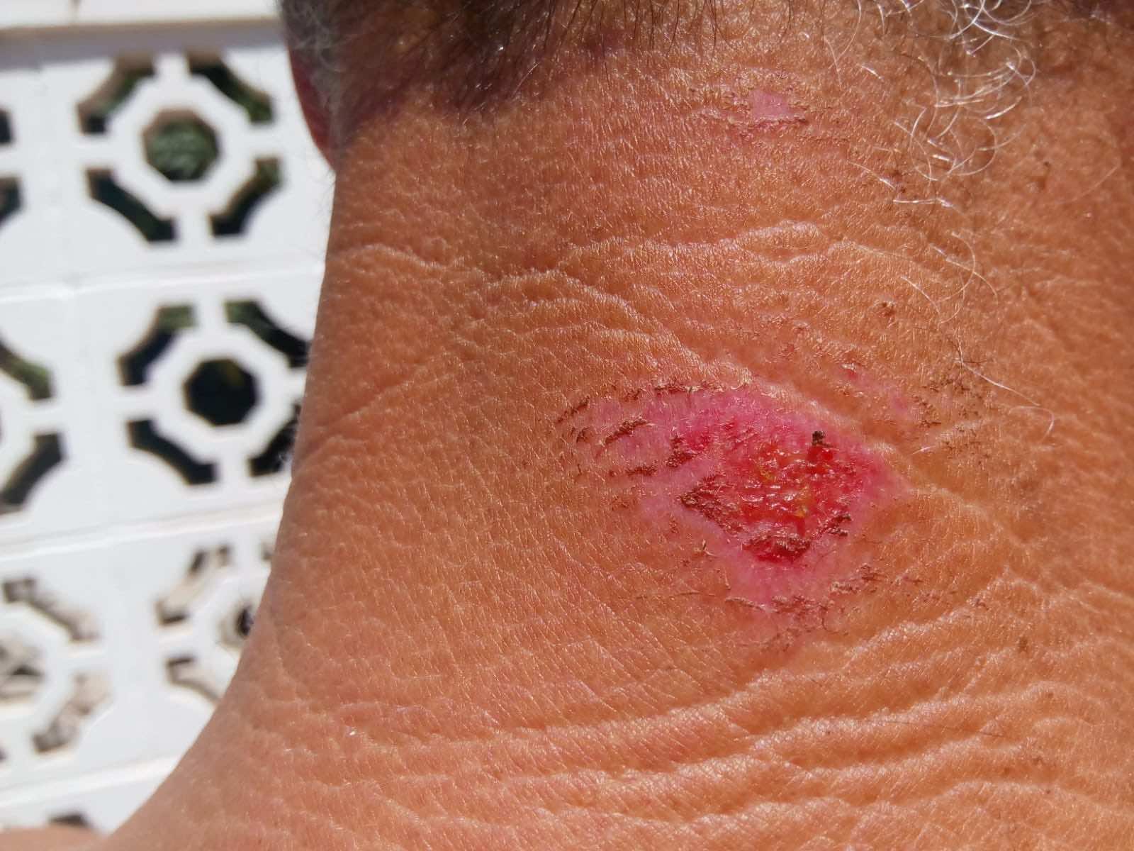 A SwimRun wetsuit neck abrasion before Aloe vera