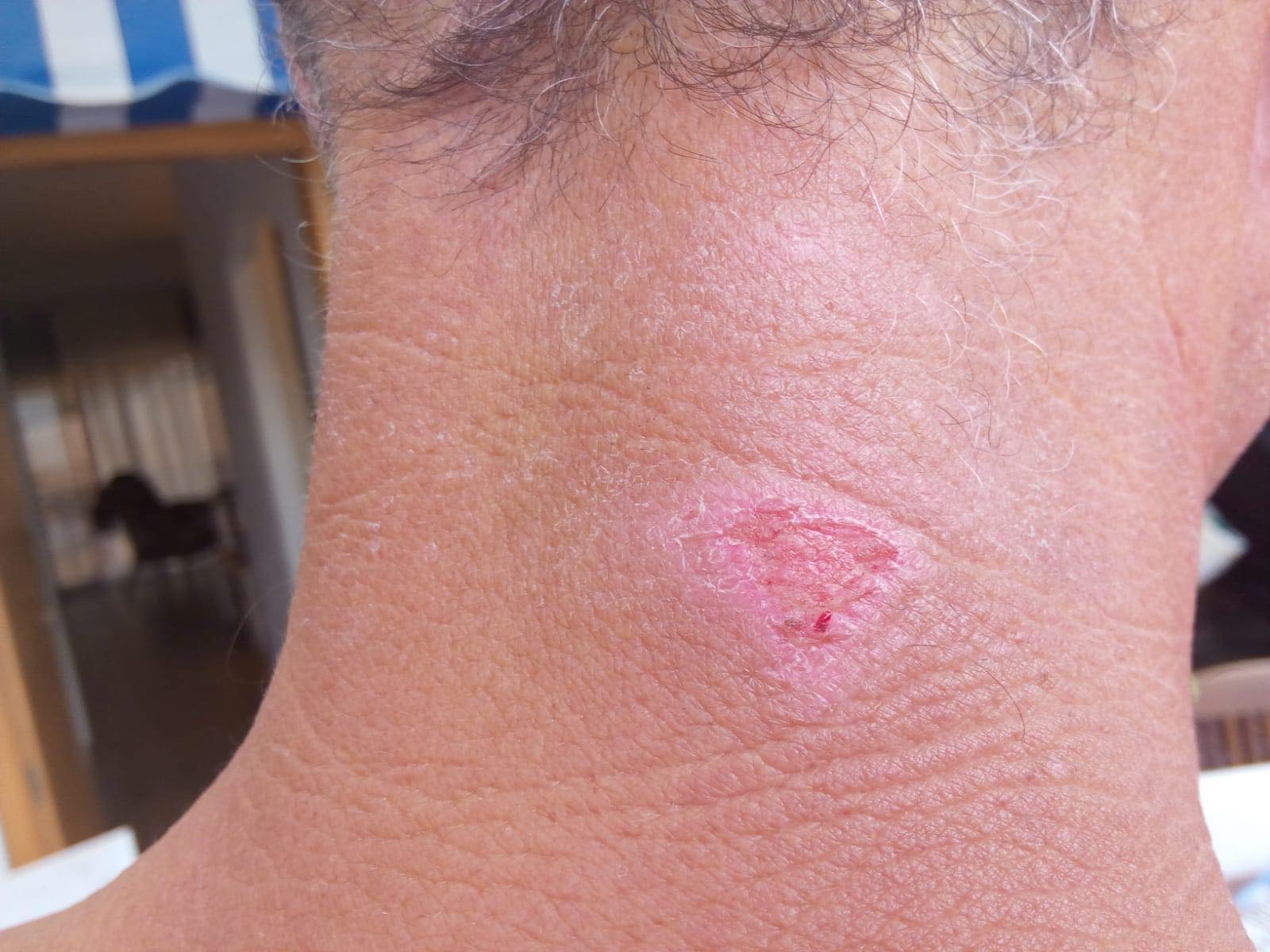 A  SwimRun wetsuit neck abrasion 48 hours after application of aloe vera