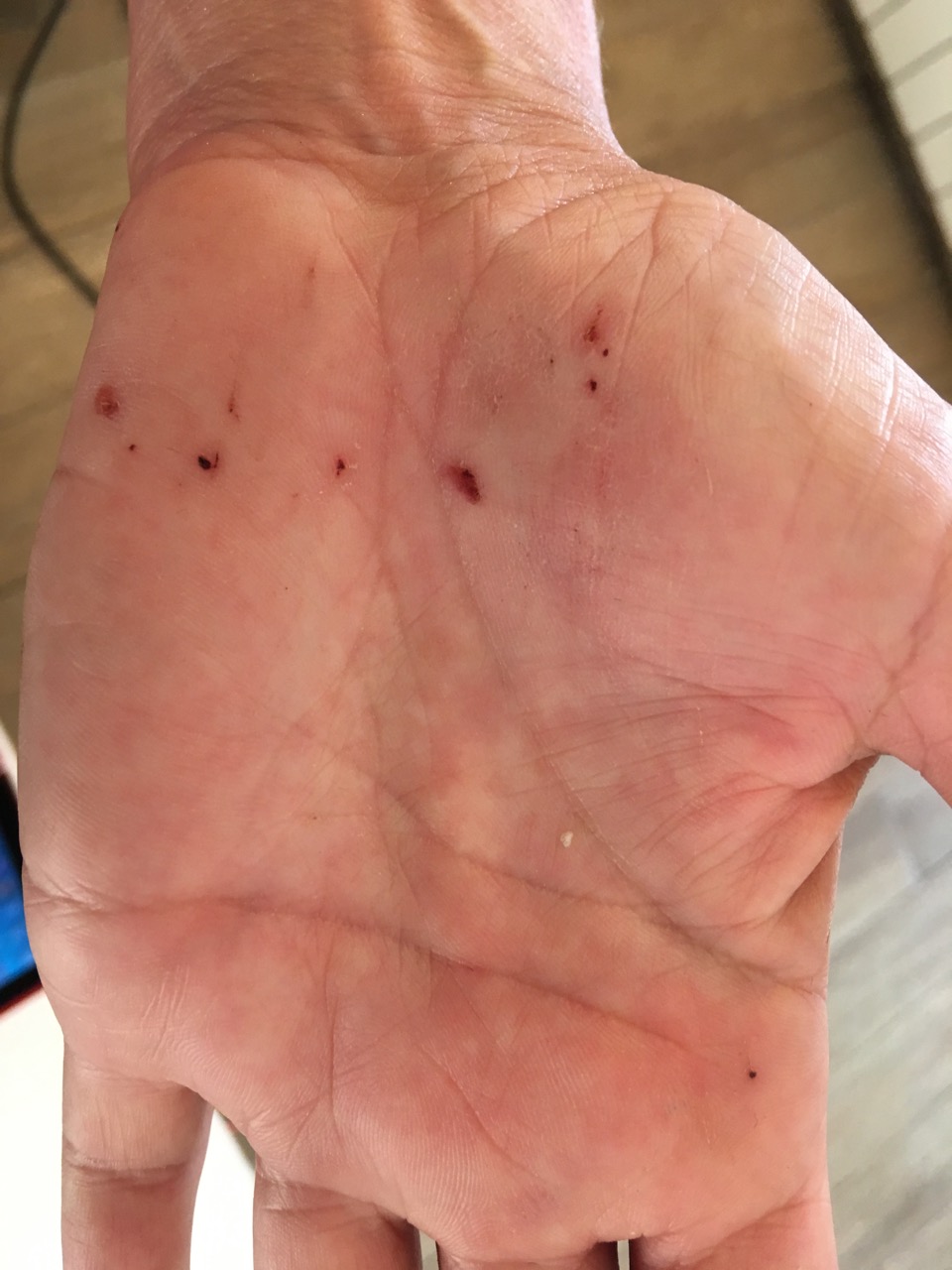 Skin abrasions on the palm of a hand Skin abrasions on the palm of a hand