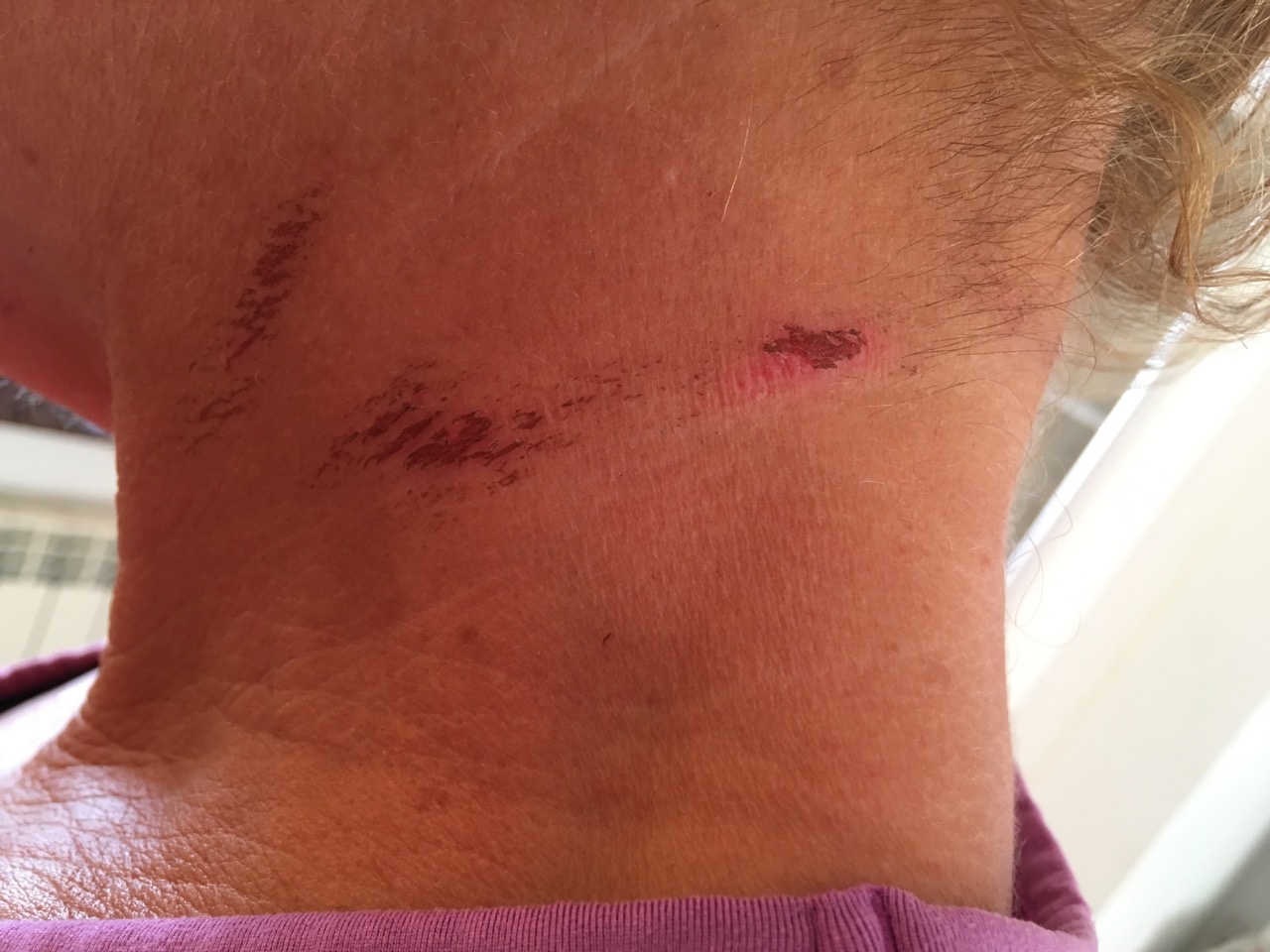 Neck abrasions from a wetsuit Neck abrasions from a wetsuit